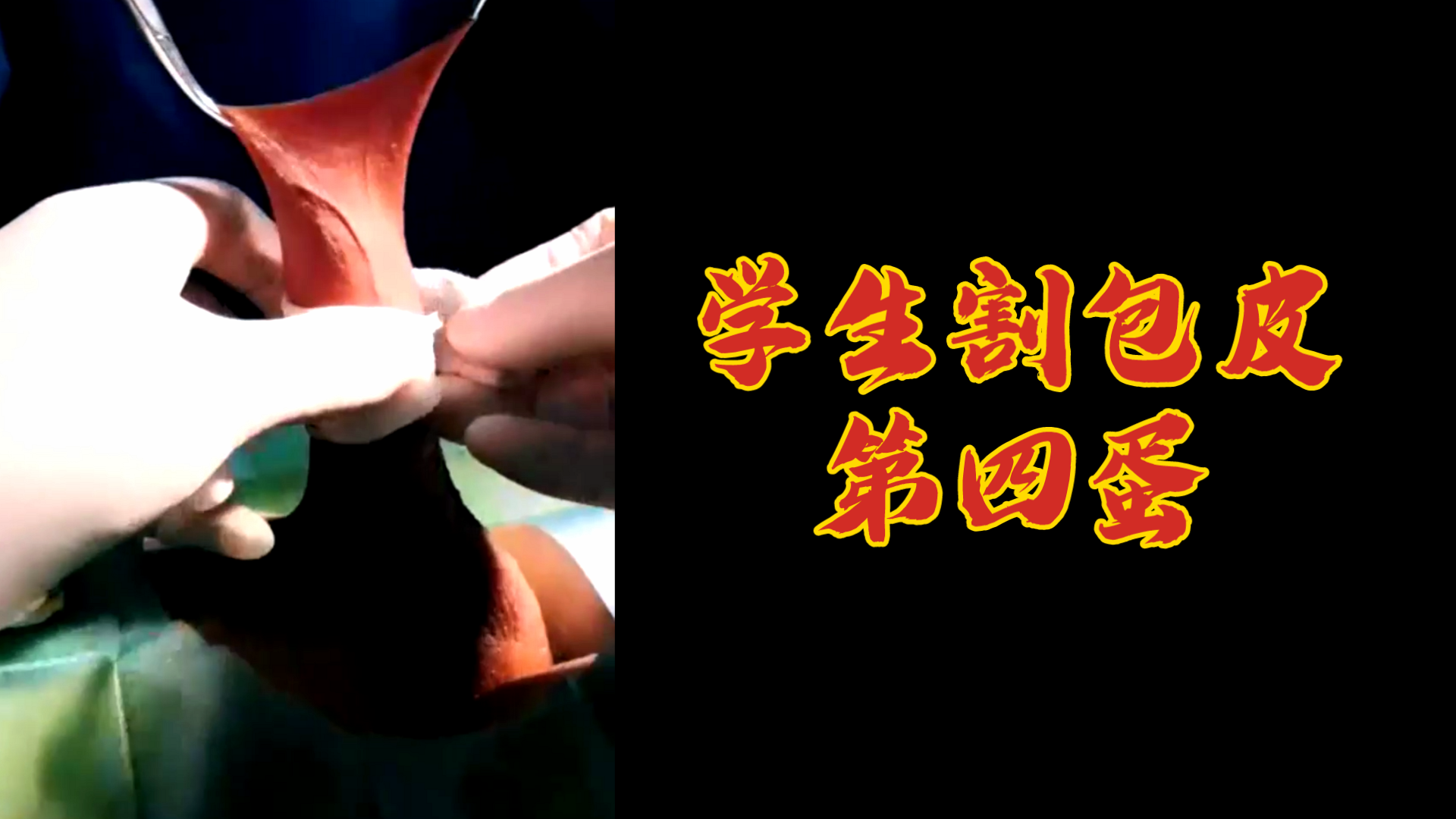 学生割包皮，第四蛋